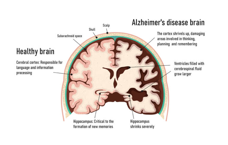 alzheimers brain diagram